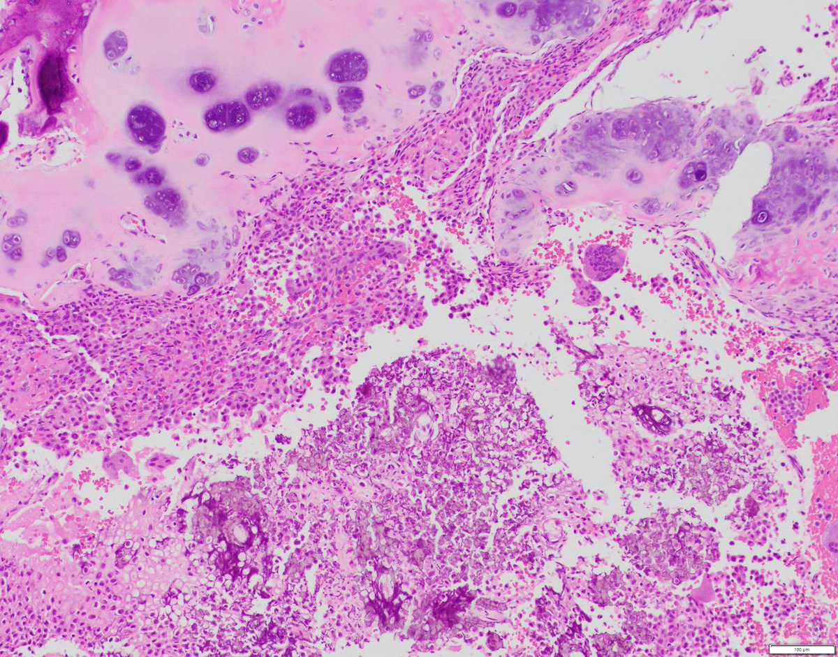 bitar_mireille's tweet photo. Lucent well-defined femoral greater trochanter bone lesion, diagnosis? driver mutation (s)? #bstpath #pathtwitter #molecpath #pedipath #pathtwitter #pathologist https://t.co/zayuAgAq39