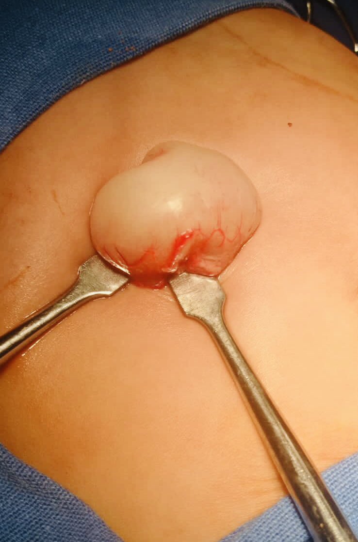 DraLisbeht's tweet photo. Pilorón 👌🏻🔪 #estenosis #piloro #cirugía #pediatrica @brunomartinezmd https://t.co/sbwATxtwhj