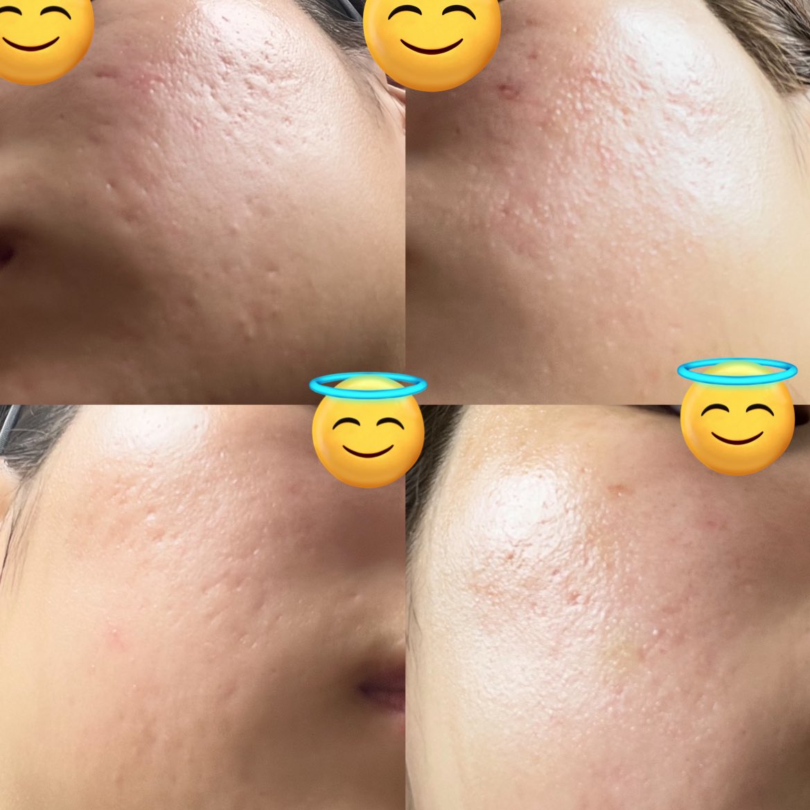 aa9o6's tweet photo. before⇔after

コラテラピー1回目👀
5日後 https://t.co/8tGcIDdwfT