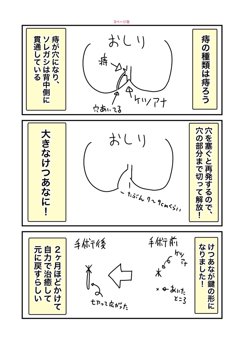 痔の手術をしてきた話(2/2) 