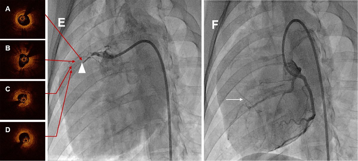 RCMjournal's tweet photo. #RCM-Vol. 24 No. 7
🌺Original Research
Mid-Term Outcomes of Novel Covered Stent with Biodegradable Membrane in Porcine Coronary Artery Perforation
💌from Lianglong Chen et al.
#CAP #DES #CAG #OCT #Stent #Coronary #Biodegradable #Porcine #PLLA
🧐Full Text
https://t.co/yCEsZrI75p https://t.co/GPqwKlGfm0
