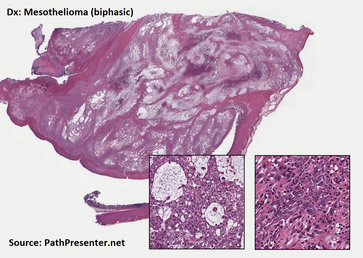 DrTravisBrown's tweet photo. Histology flash card
Malignant mesothelioma
Rare
Strong assoc asbestos exposure
Oft 5-7th decade
Dx average 2-4 decades after asbestos exposure
Median survival ~1yr
Histo variants
-epithelioid
-sarcomatoid
-mixed
Ep 8 #ThisPathLife #podcast in the backlog of @ThisMedicalLife https://t.co/nfSV04hJsk