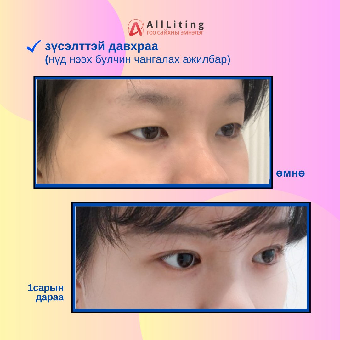 #ҮЙЛЧЛҮҮЛЭГЧИЙН_БОДИТ_ҮР_ДҮН
#ALL_Liting
хийлгэсэн ажилбар
📷Зүсэлттэй давхраа
/нүд нээх булчин чангалах ажилбар хийгдсэн/
-------------------------
📷📷 ҮЗЛЭГ/ЗӨВЛӨГӨӨ үнэгүй хийж зөвхөн таньд тохирсон мэс заслын төлөвлөгөөг гаргана.
📷монгол ажилтан: 010-4931-4451