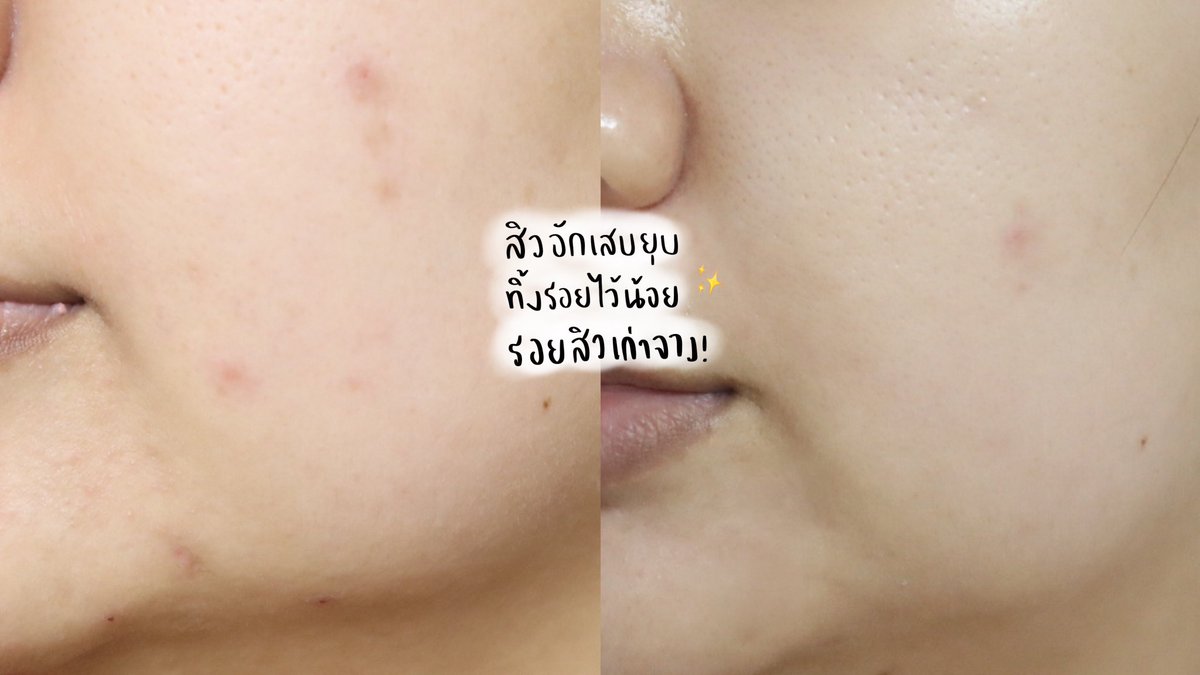 yingpeereview's tweet photo. มีตัวช่วยสำหรับผิวเป็นสิวมาบอกจ้า MORTIW ACNO 552mg ช่วยกู้สิวได้ดีมาก เขาใส่แต่สารสกัดที่มีง่นวิจัยรองรับ แล้วมีสารสกัดมะเขือเทศที่ช่วยดูแลแผลจากสิวไปพร้อม ๆกัน ก็คือดูแลสิวป้องกันสิวเกิดใหม่และบำรุงผิวไปด้วย ชอบบ 💖😳 #หมอทิว #ใช้ดีบอกต่อ #สิว #รักษาสิว #แอคโน่ #Acno #MORTIW https://t.co/8zozgyA1wt