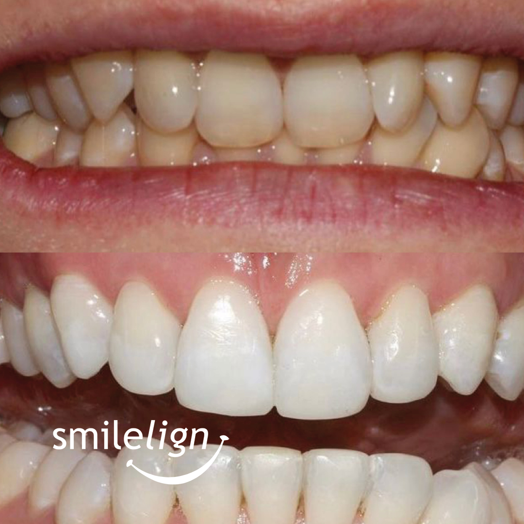 smilelign's tweet photo. Before and After Smilelign treatment!

We always love to see the outcome of Smilelign aligners, so here's another for you too! Start your journey here: https://t.co/5ol85k4uCt https://t.co/02g4XIn2ff