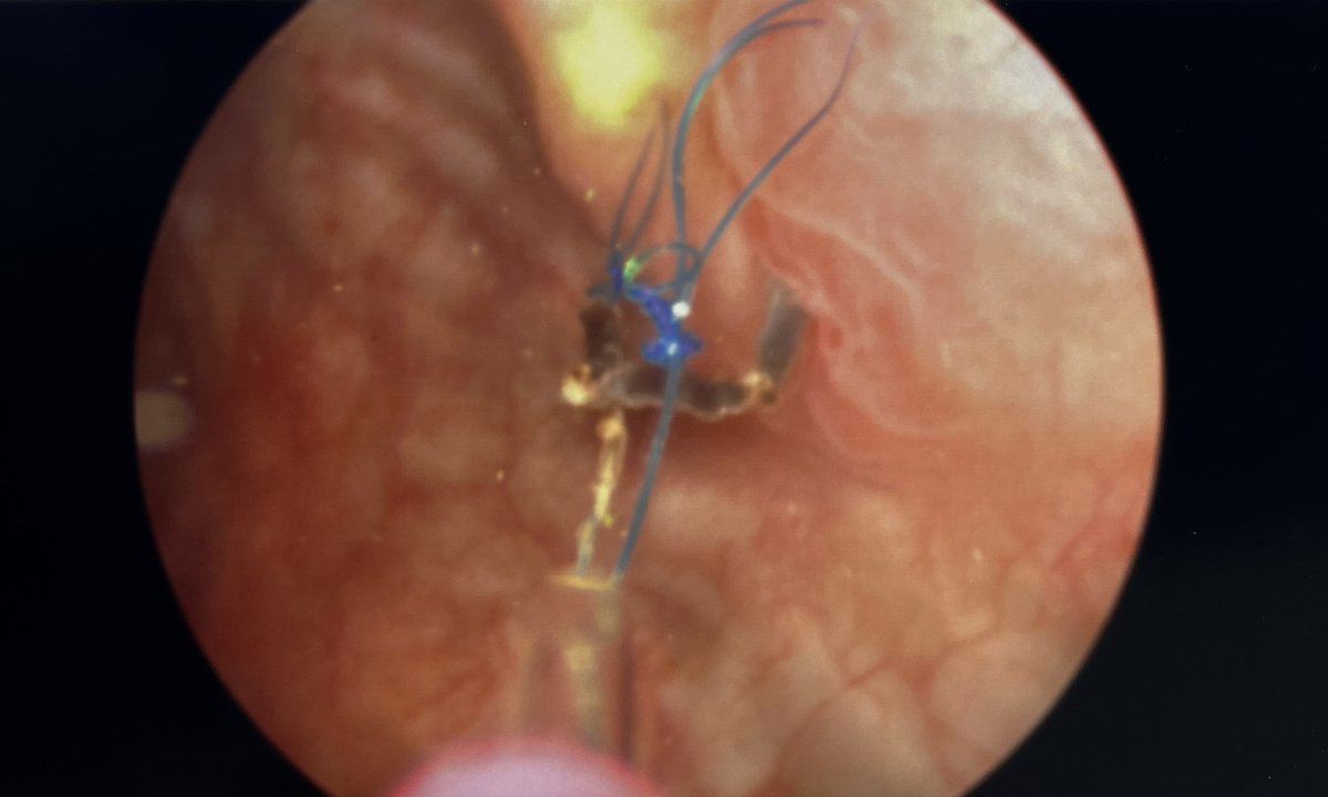 Kidney transplant recipient referred for bladder calculus. Looks like prolene at the anastomosis from nearly 30 years ago! Reminder to always use absorbable suture in the GU tract!