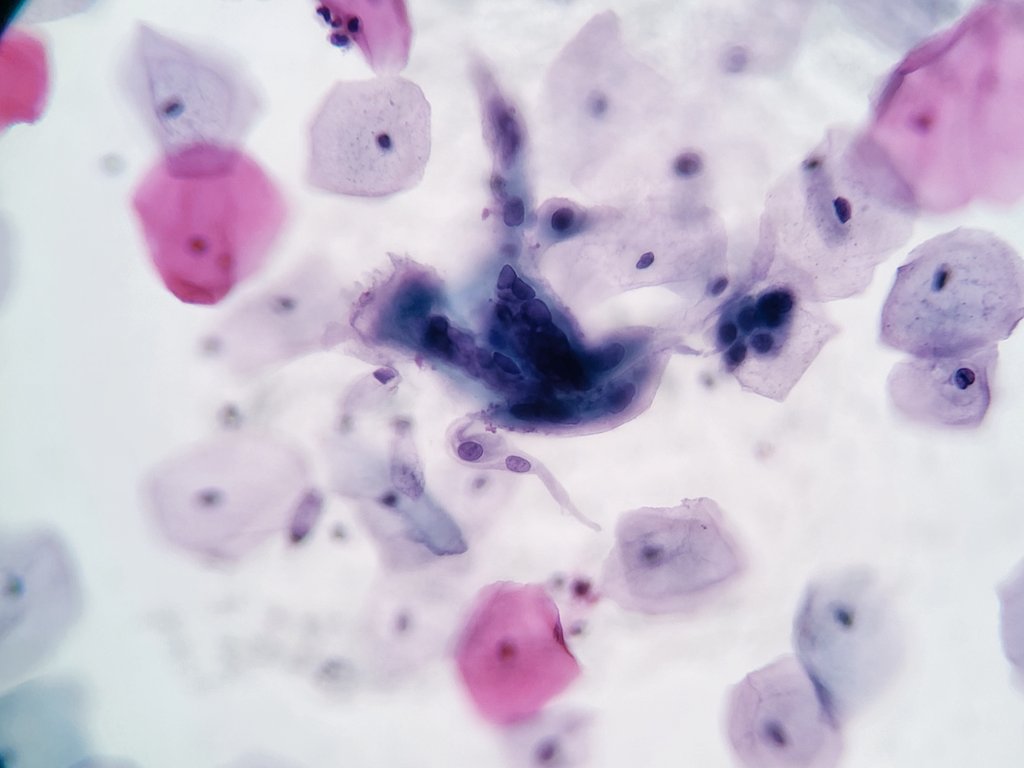 Nice catch!
In #papsmear
Can you see it 👀

#gynaepath #gupath #pathology