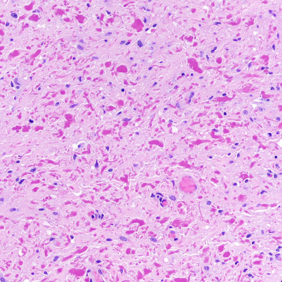 Craig Horbinski (@craighorbinski) on Twitter photo This might LOOK like a pilocytic astrocytoma, but it's actually piloid gliosis adjacent to an ependymoma. Tricky! #pathology #neuropath #PathTwitter This might LOOK like a pilocytic astrocytoma, but it's actually piloid gliosis adjacent to an ependymoma. Tricky! #pathology #neuropath #PathTwitter
