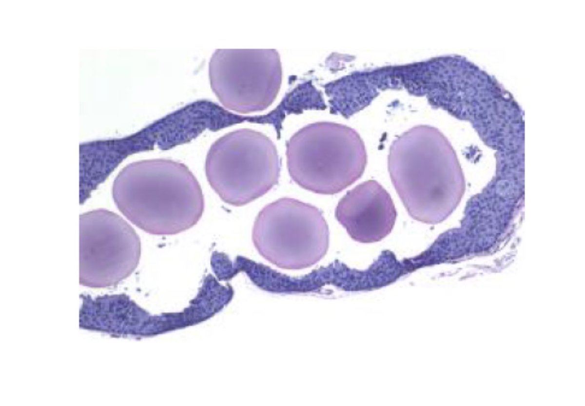 Hi #PathTwitter 😊! I need some help. @ParasiteGal @yro854 @DiegoMoralesN @kdoc62 - anyone!. This older female was trimming trees/hedges a few weeks ago and felt something (“foreign body sensation”)in her eye. Any clue what it may be? Left is sclera right photomicrograph.