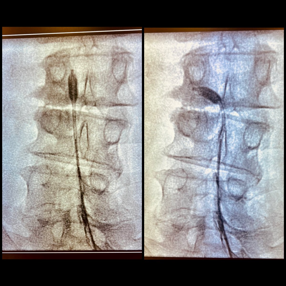 🔵Epidural balloon neuroplasty🔵
Lumbar spinal stenosis in whom epidural block or neuroplasty achieved short-lived effects
✅ Accurate balloon at the target.
✅ Ballooning more than 50% target.
✅ Complete contrast dye spread.
<a href="/quironsalud/">quirónsalud</a> Bizkaia Vitoria
#painrelief #pain