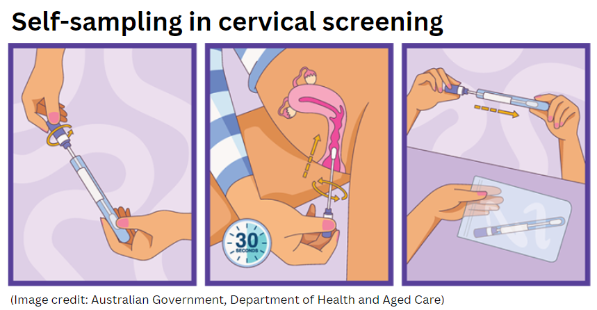 NSShse's tweet image. Would #HPV self-sampling appeal to women who have never had cervical #screening or those who don't attend screening regularly?

We're researching the potential role #selfsampling could play in #cervicalscreening in #Ireland. 

👉tinyurl.com/4v844eb4 

#ChooseScreening