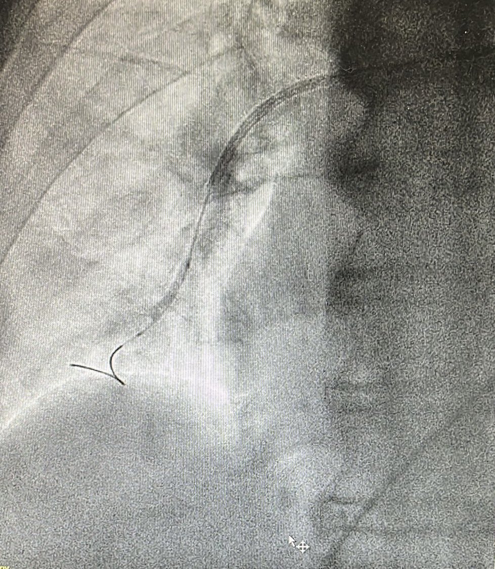 Pretty cool day at #nhcs. #laac and #tricvalve without GA using #miniTEE. Ending with an interesting #bpa case. #NhcsStructural #Structuralintervention @khungkeong @wongningyan @jacktanwc