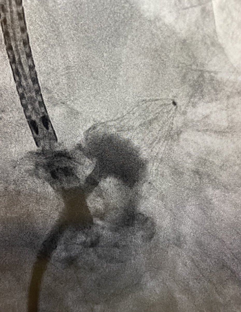 Jonyap88's tweet photo. Pretty cool day at #nhcs. #laac and #tricvalve without GA using #miniTEE. Ending with an interesting #bpa case. #NhcsStructural #Structuralintervention @khungkeong @wongningyan @jacktanwc https://t.co/NFuumVplhu