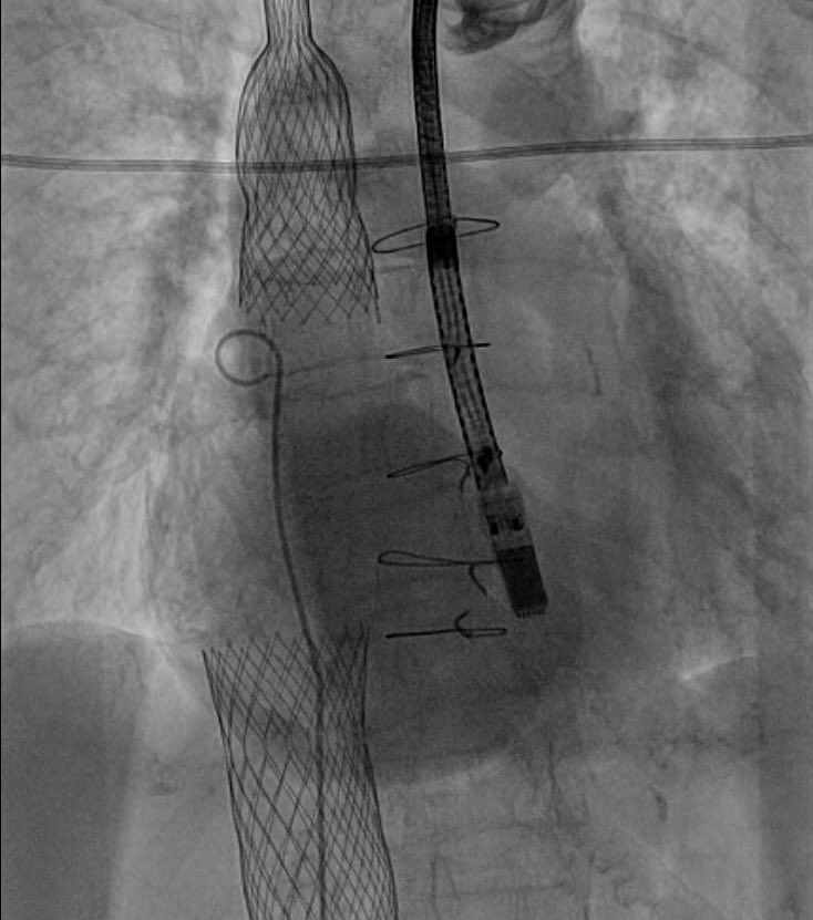 Jonyap88's tweet photo. Pretty cool day at #nhcs. #laac and #tricvalve without GA using #miniTEE. Ending with an interesting #bpa case. #NhcsStructural #Structuralintervention @khungkeong @wongningyan @jacktanwc https://t.co/NFuumVplhu