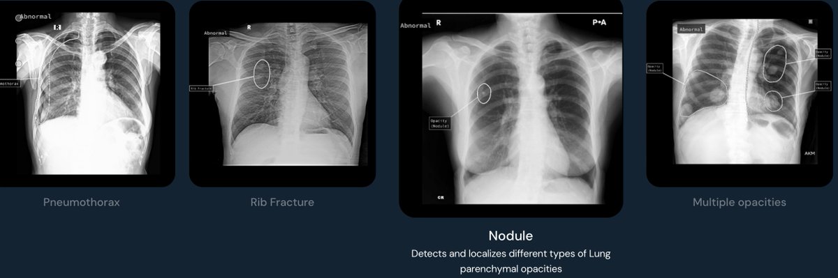 Chest X-rays indicating cancers? #AI tool from @qure_ai flagged #lungcancer cases putting them straight-to-CT pathway. Dr. Indrajeet Das @dr_raj_das explains @Leic_hospital lnkd.in/gnYw3U9j