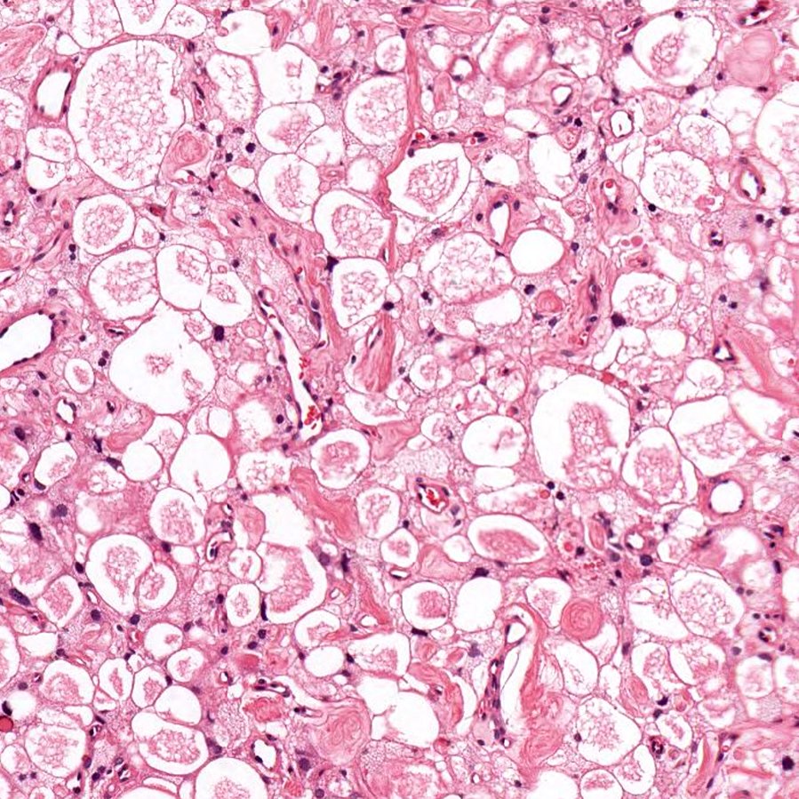 This doesn't look at all like a #meningioma, but it is. What subtype do you think it is? What chromosomal abnormality is characteristic of this subtype? #pathology #neuropath #pathtwitter