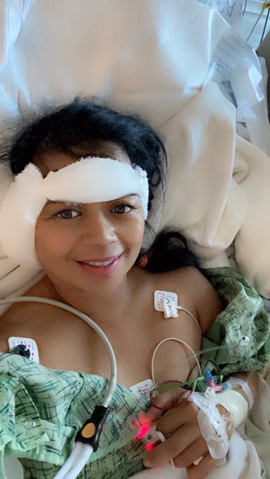 Before and after my micovascular decompression surgery on Wednesday. Now, let the healing begin! https://t<a href="/tag/genbbq"class="tags"><span>#genbbq</span></a>