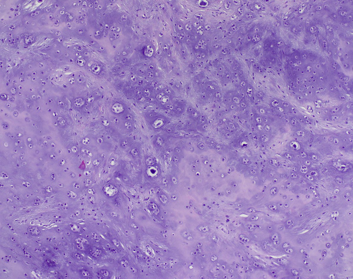 70s♂️scalp RO Pilar Cyst
Something we don't see everyday, especially at this site (scalp)
#dermpath <a href="/mccalmo/">Tim McCalmont</a> <a href="/HENRYY_MD/">Henry YANG</a> <a href="/JamesSampson123/">James Sampson</a> <a href="/DrAldehyde/">Woo Cheal Cho, MD</a> <a href="/ViralBhanvadia/">Viral Bhanvadia</a> <a href="/gonzadetoro/">Gonzalo De Toro</a> <a href="/DanGrahamMD/">Dan Graham</a> <a href="/PIorfino/">Dermpath_doc_trish</a> <a href="/DrGeeONE/">Olaleke Folaranmi</a> <a href="/ChristineJKoMD/">Christine J. Ko, MD</a> <a href="/DiegoMoralesN/">Diego Morales, MD</a> @ArjunRamaiya1 <a href="/VHNguyenMD/">Van-Hung Nguyen MD 🇺🇦🌻</a>