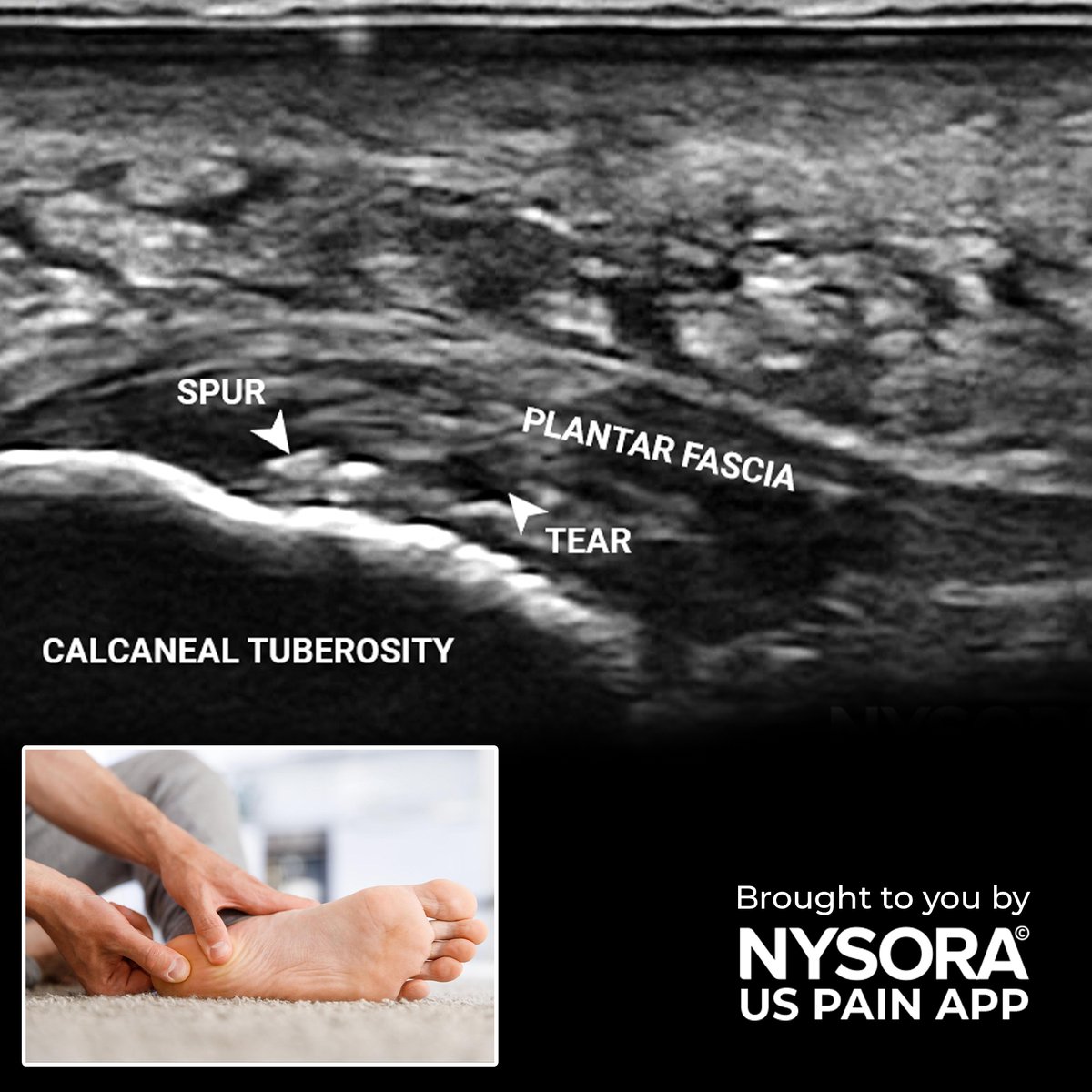 NYSORA's tweet photo. ๐ Just released on NYSORA's #USPain app: a fascinating case study on Plantar #fasciopathy โ Injection! Download the US Pain app now and unlock a treasure trove of fresh case studies and technique walkthroughs every single week! ๐ฒ
https://t.co/us6yoFohOF
#NYSORA https://t.co/CeOJ8E6WuP
