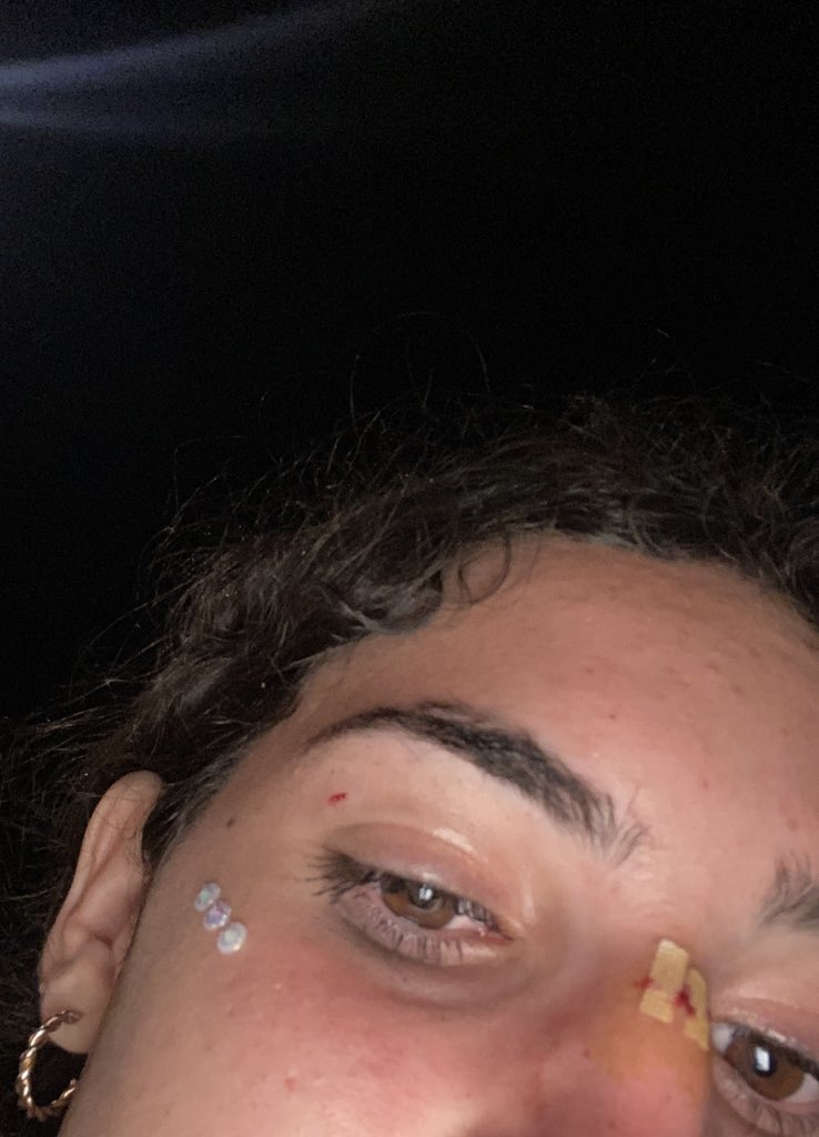 aannaagrciiaa_'s tweet photo. he acabado haciéndome 300km para ver a @eladiocarry_on y ha tirado los zapatos y me ha dado uno en la cara que me ha medio matado, me han tenido que poner puntos en la cara, me ha roto mis gafas y me he perdido el final del concierto por estar con los médicos.🤝🤝🤝 https://t.co/jbhh5Zg8qU