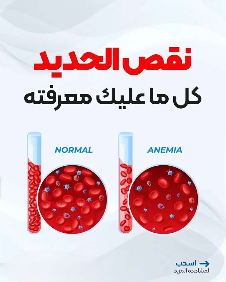 a_hlam07's tweet photo. 🔴 #فقر_الدم 🔴

كل ماتريد معرفته عن فقر الدم

اسباب وعلاج 

#ساعه_استجابه https://t.co/A5VQgamYcD