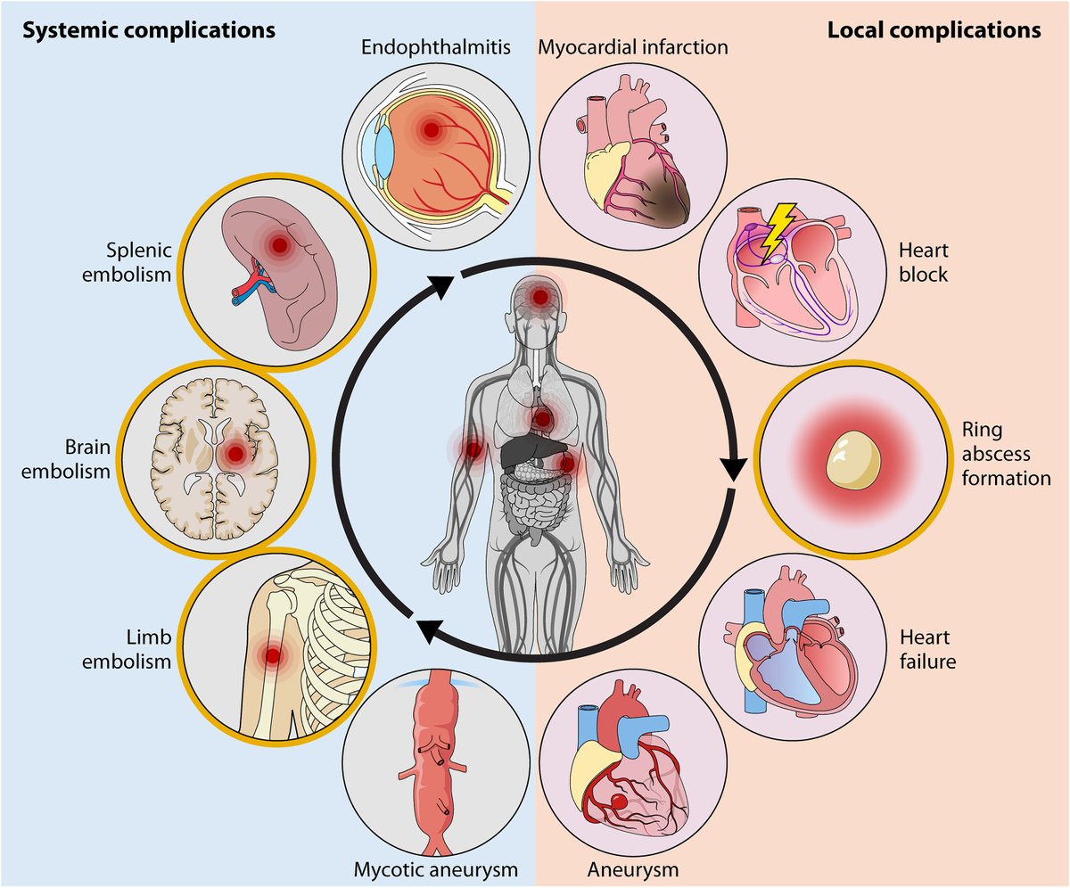 ICYI, we wrote what I expect will be the definitive review on fungal #endocarditis for years to come. Published in #ClinMicroRev

Congrats to @GRThompsonMD and @martinhoenigl for leading this effort, and to all co-authors 

journals.asm.org/share/UA3VQ7P3…