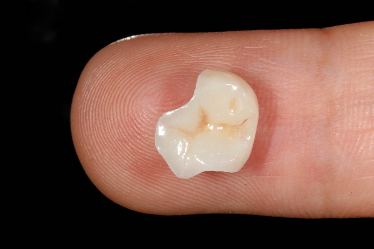 BitehausDent's tweet photo. Preservación de Cúspides 
#incrustacion  #onlay  #restorativedentistry #dentalphotography  #macrophotography #prosthodontics #canonphotography #dentistry https://t.co/ED8Uyyi71F