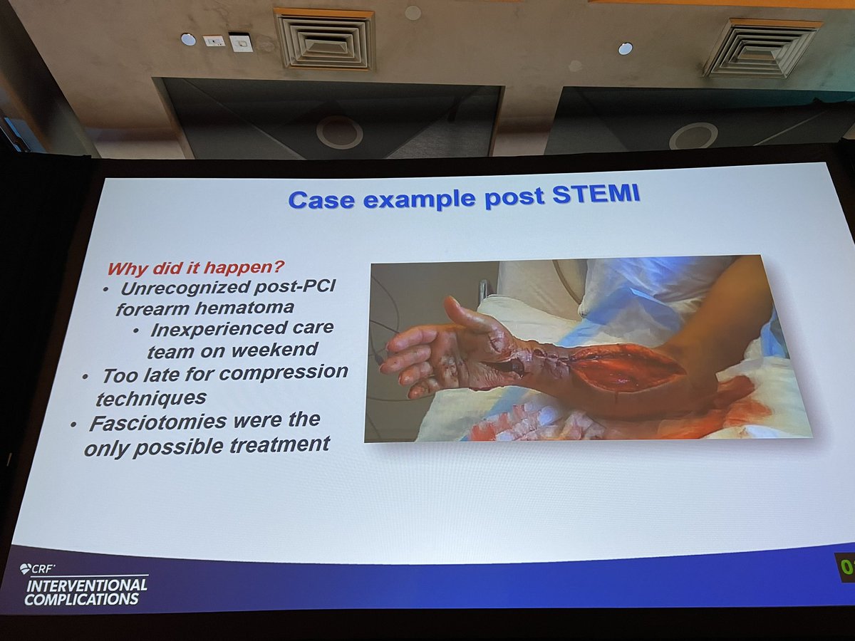 Radial can have complications too — awesome talk by <a href="/RinfretStephane/">Stéphane Rinfret, MD SM</a> at #CompCourse2023 <a href="/crfheart/">Cardiovascular Research Foundation</a>