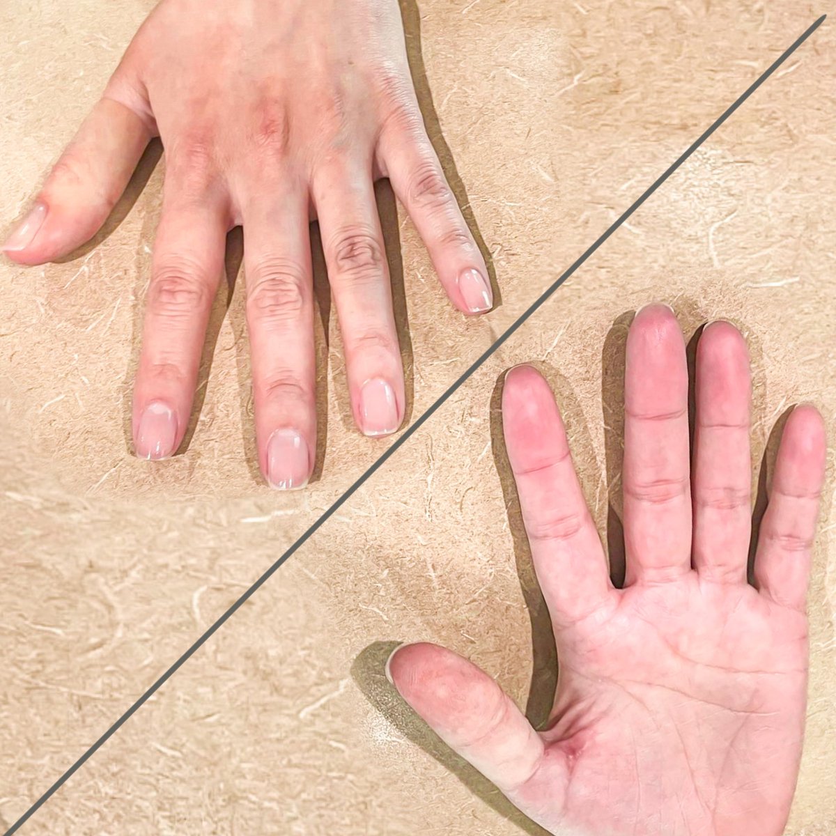 Can you spot the silicone prosthetic finger? 🤚 This patient lost her thumb in an accident. After her surgery we created her custom high realism silicone prosthetic finger. Great job by our anaplastology team!
#tampa #florida #orlando #prostheticlimbs #prosthetists #amputation