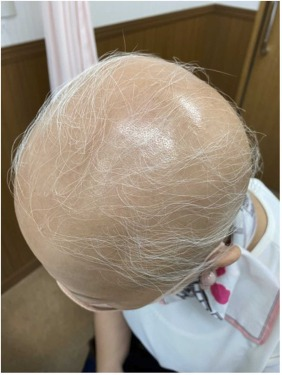Storiesofinjury's tweet photo. A previously healthy woman in her 40's lost most of the hair on her head, and also lost her eyebrows, eyelashes, axillary hair, pubic hair, and hair on the arms and legs one week after the 1st Moderna COVID Vaccine.  She was diagnosed with Alopecia Universalis.

https://t.co/YHlLNgnrgv