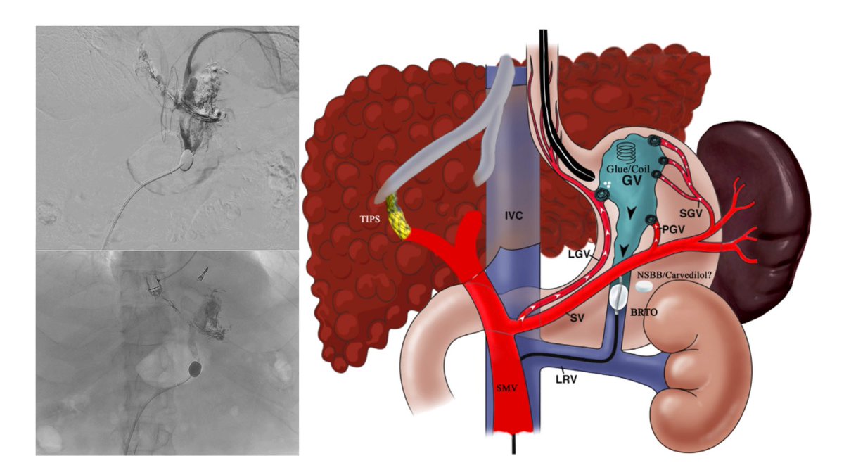 GWENT IR (@gwent_ir) on Twitter photo First @ GrangeUniversityHospital. BRTO case in a patient with gastric varices. Lovely to work with a great bunch of hepatology <a href="/GwentLiverUnit/">Gwent Liver Unit</a> and ITU colleagues.
#IRad #BRTO #PatientCare
<a href="/NimitGoyal111/">Nimit Goyal</a>, C Chick, C Williams First @ GrangeUniversityHospital. BRTO case in a patient with gastric varices. Lovely to work with a great bunch of hepatology <a href="/GwentLiverUnit/">Gwent Liver Unit</a> and ITU colleagues.
#IRad #BRTO #PatientCare
<a href="/NimitGoyal111/">Nimit Goyal</a>, C Chick, C Williams