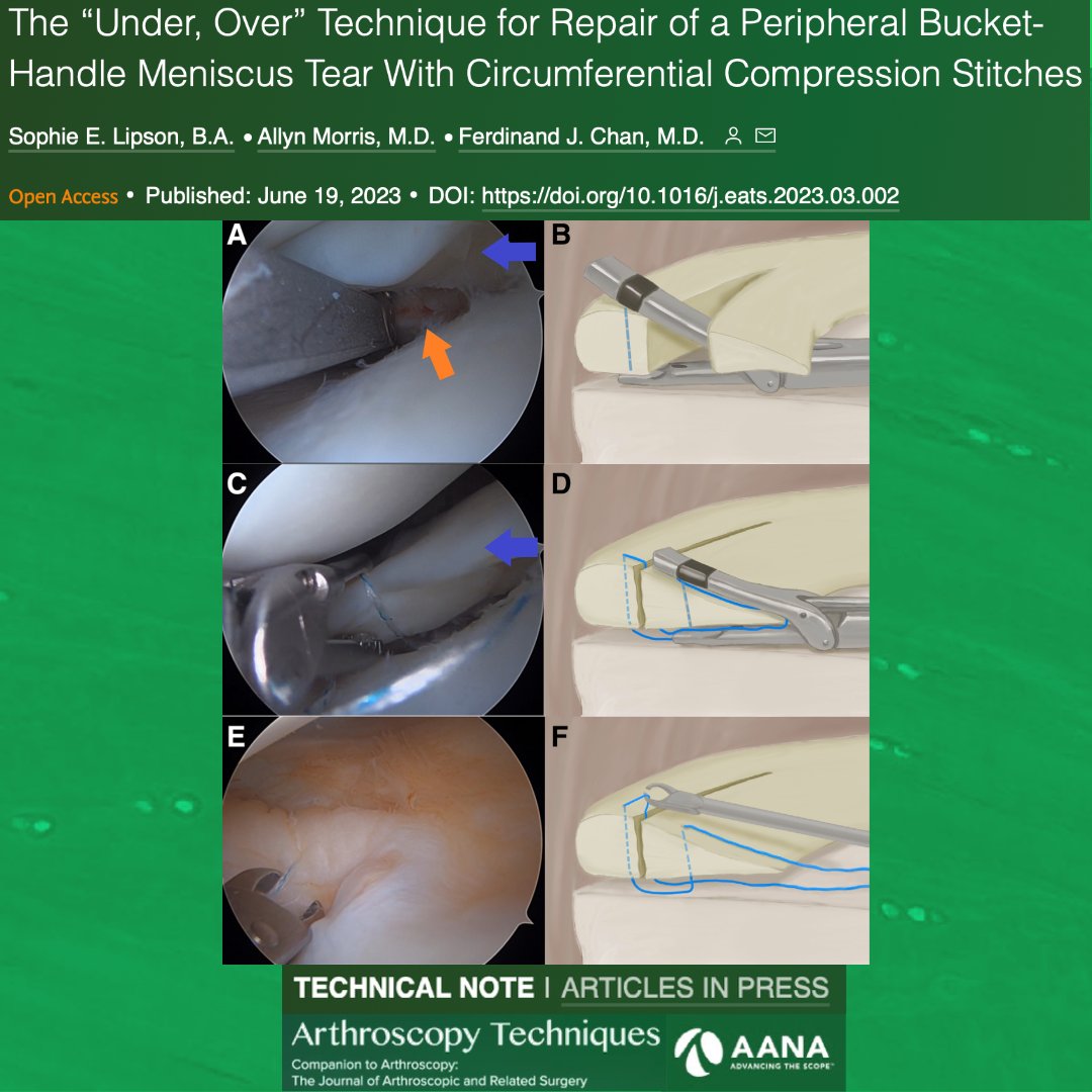 ArthroscopyJ's tweet photo. This paper describes a technique for repairing large peripheral meniscus tears using circumferential compression stitches. https://t.co/w9hTarQzxi. @TuftsMedSchool @MontefioreOrtho #Meniscus #AllInside https://t.co/e4cw0kqqoV