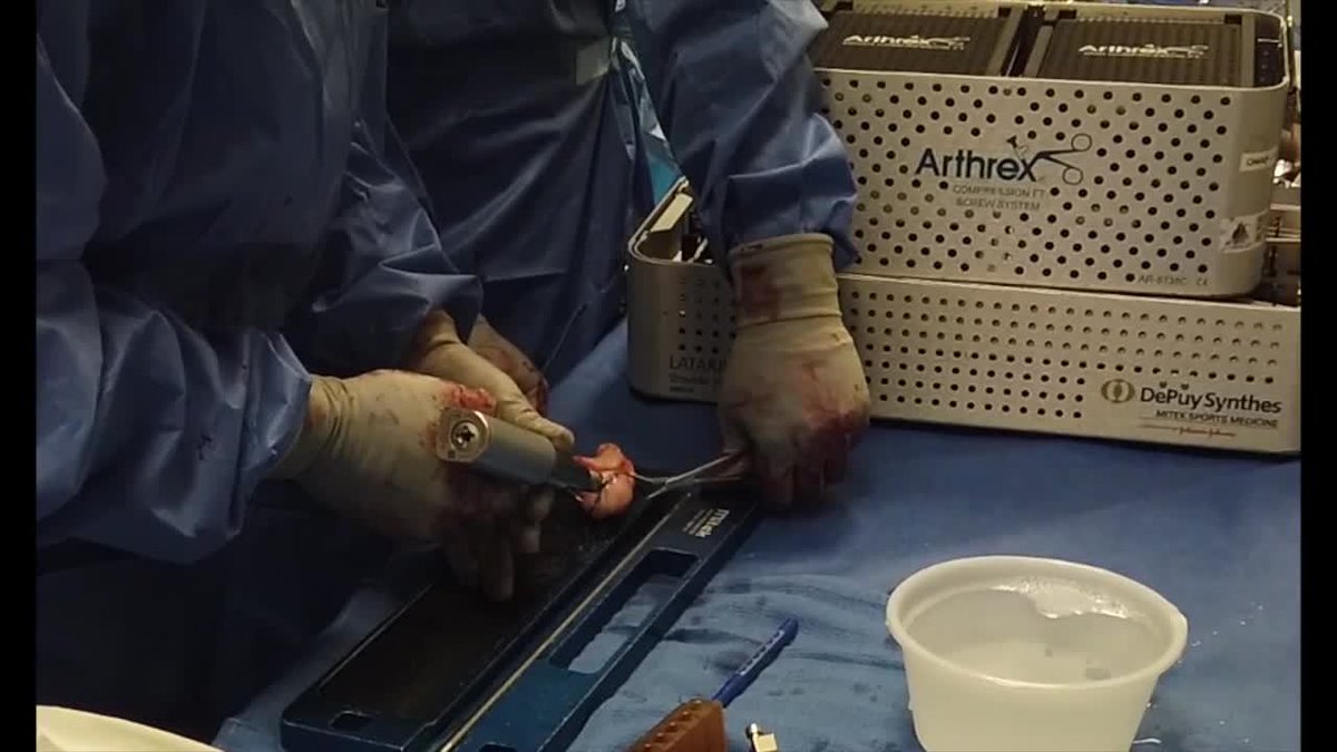 Watch a #Humeral Head and #GlenoidReconstruction with Fresh #Allograft for Fixed #AnteriorShoulderDislocation on Orthopaedic Video Theater: bit.ly/3PLxuiP #OVTFridays #OrthoTwitter #orthopedic @skbishai @BeaumontHealth @ASESmembers @otatrauma