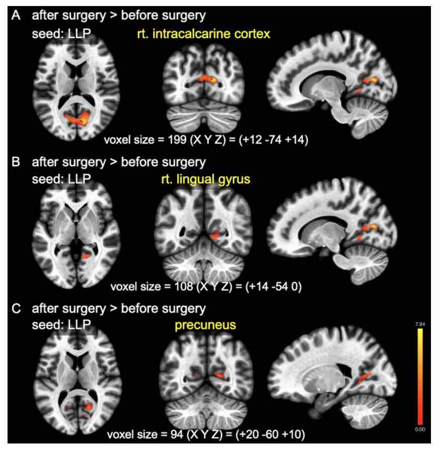 #OnlineFirst: Effects of carotid revascularization on cognitive function and brain functional connectivity in carotid stenosis patients with cognitive impairment: a pilot study. 

thejns.org/view/journals/….
