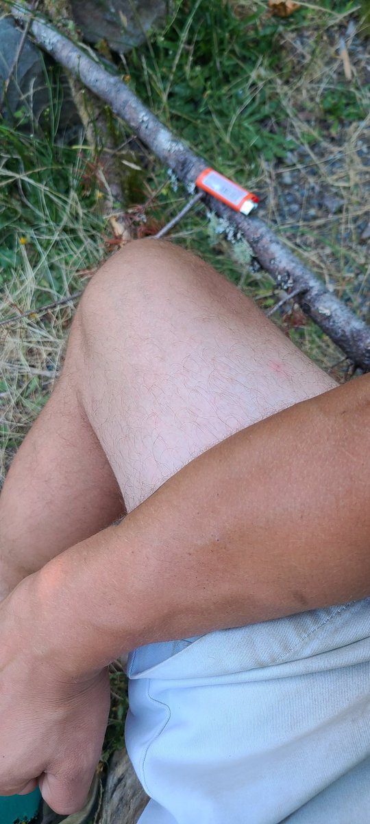 No_Name_Bum's tweet photo. I tan so well, but my "true white" oof.
#melanindeficient #snowroach https://t.co/bsbHo7cH6Q