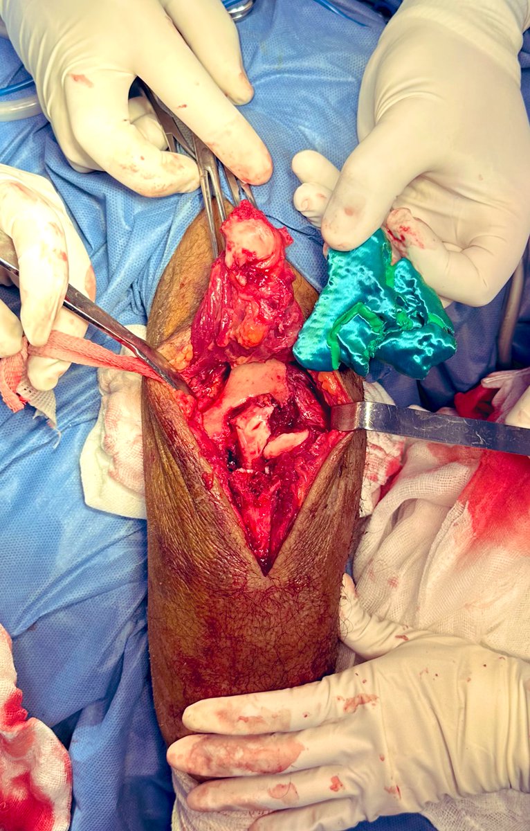 OrtoDrJuarez's tweet photo. Fractura de humero distal con placas de reconstrucción ( sin placas anatómicas) pero impresión 3D no puede faltar  #orthotwitter #3dcot #3dprint @BambulabGlobal #fractura https://t.co/I7iAHgjDQ6