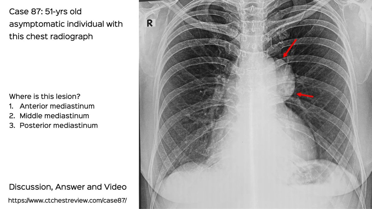 Case 87: 51-years old with an incidental finding

Where is the lesion
1. Anterior mediastinum
2. Middle mediastinum
3. Posterior mediastinum

Discussion, answer video

ctchestreview.com/case87/

#chestrad #ctchest #FOAMrad #radres #mediastinum #mediastinalmass #Felson