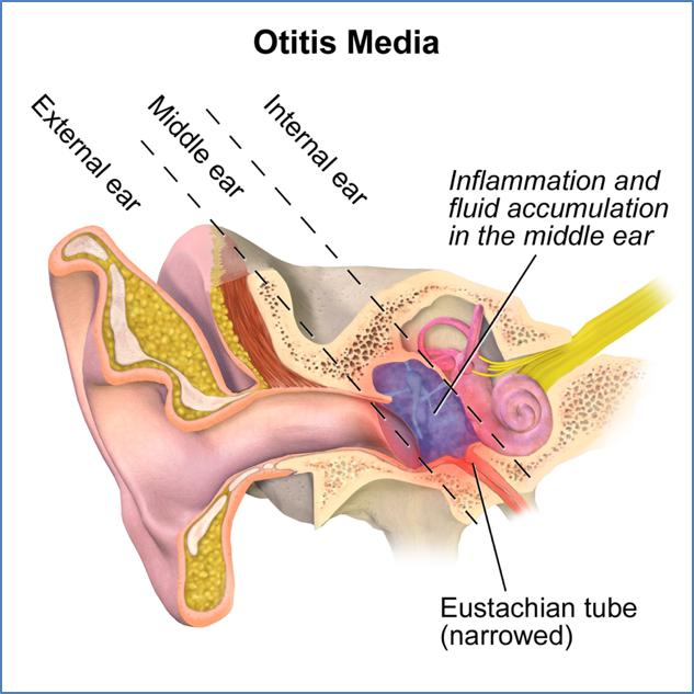MedStudentNote1's tweet photo. 🩺🧑🏻‍⚕️Diagram of the Hour: Otitis Media

📑🤓 For medical study resources, check out our High-Yield PDF Medical Study Notes, available here 👉 https://t.co/NvqXYlgBzv 👈

🚨Get 80% OFF our Entire Bundle Deal Today!🚨

#medstudentnotes #medstudent #medicalstudent #MDstudent https://t.co/a71tSSBfwa