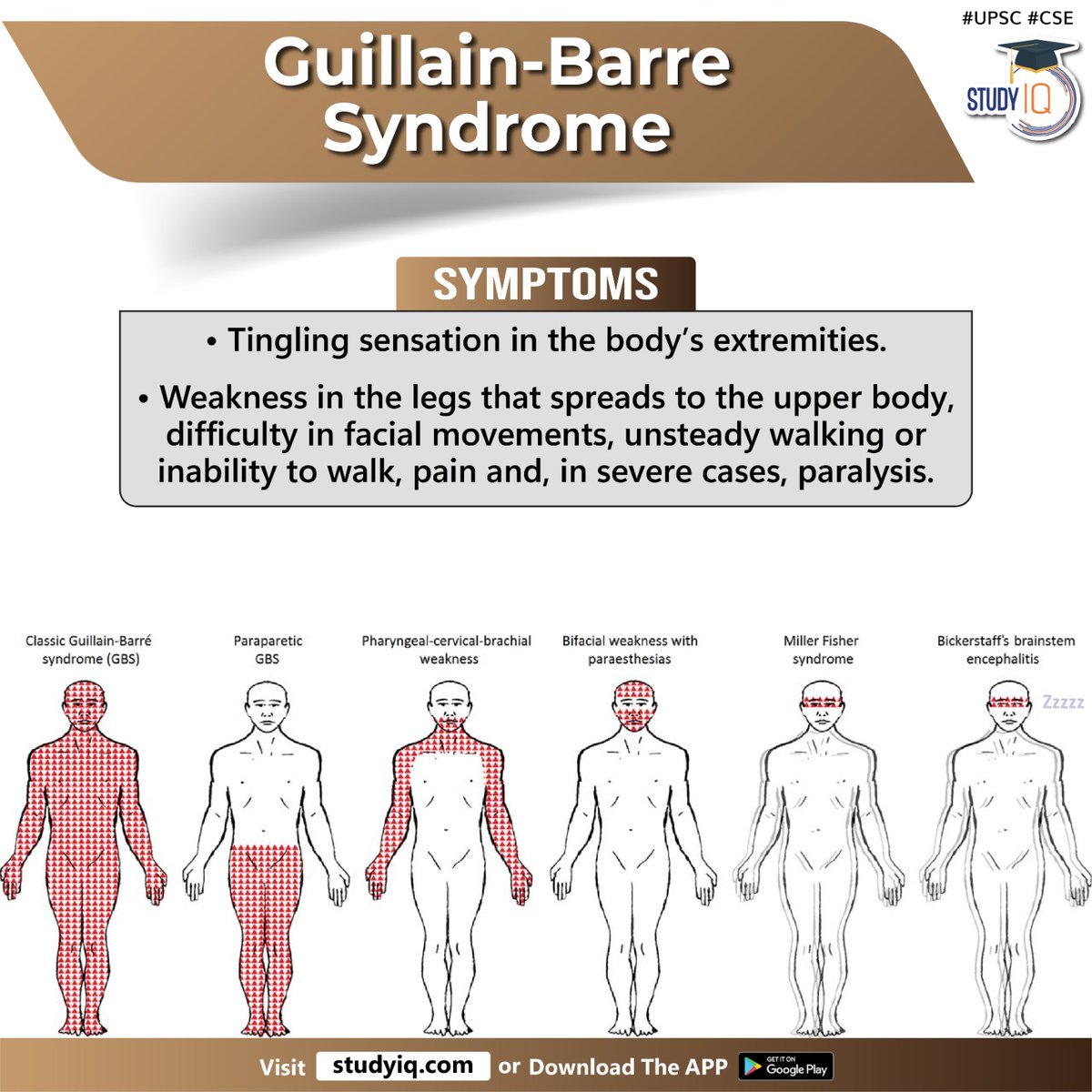 Guillain-Barre Syndrome

#guillainbarresyndrome #peruviangovt #nationalemergency #neurologicaldisorder #immunesystem #foreignbodies #nervecells #myelinsheath #cytomegalovirus #epsteinbarrvirus #zikavirus #covid19 #gbs #plasmaexchange #blood #plasmaproduction #blooddonors #upsc