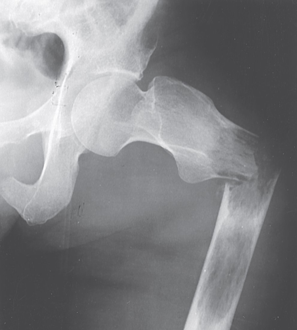 There’s no evidence that #NSAIDs impede #fracture healing. @blakebriggsMD reports on the best strategy for fracture pain (yep, it includes NSAIDs). #FOAMed bit.ly/3PCPYp8