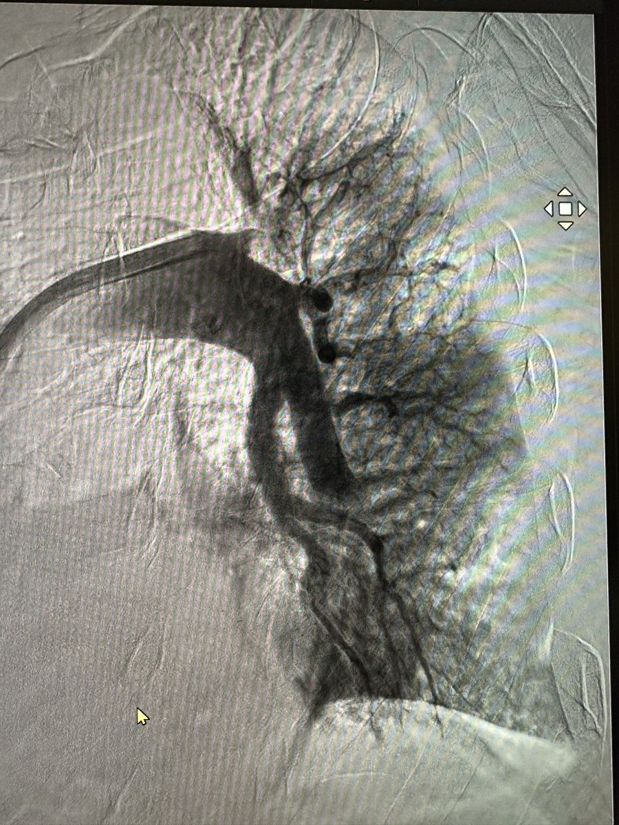 AntoniousAttall's tweet photo. @ShariqShamimMD @JayMathewsMD @DrJayMohan @jaygirimd @DrAmirKaki @PERTConsortium @SripalBangalore @Babar_Basir @drandrewsharp @EM_RESUS So w did this last week as part of #STRIKEPE with @PenVascular #flash16. Mech thrombectomy does what it’s supposed to but the more you do, you realize that there are many phenotypes. Remarkably regardless of degree of mPA reduction these pts still do well. We need more data. https://t.co/kL2om1l3cr