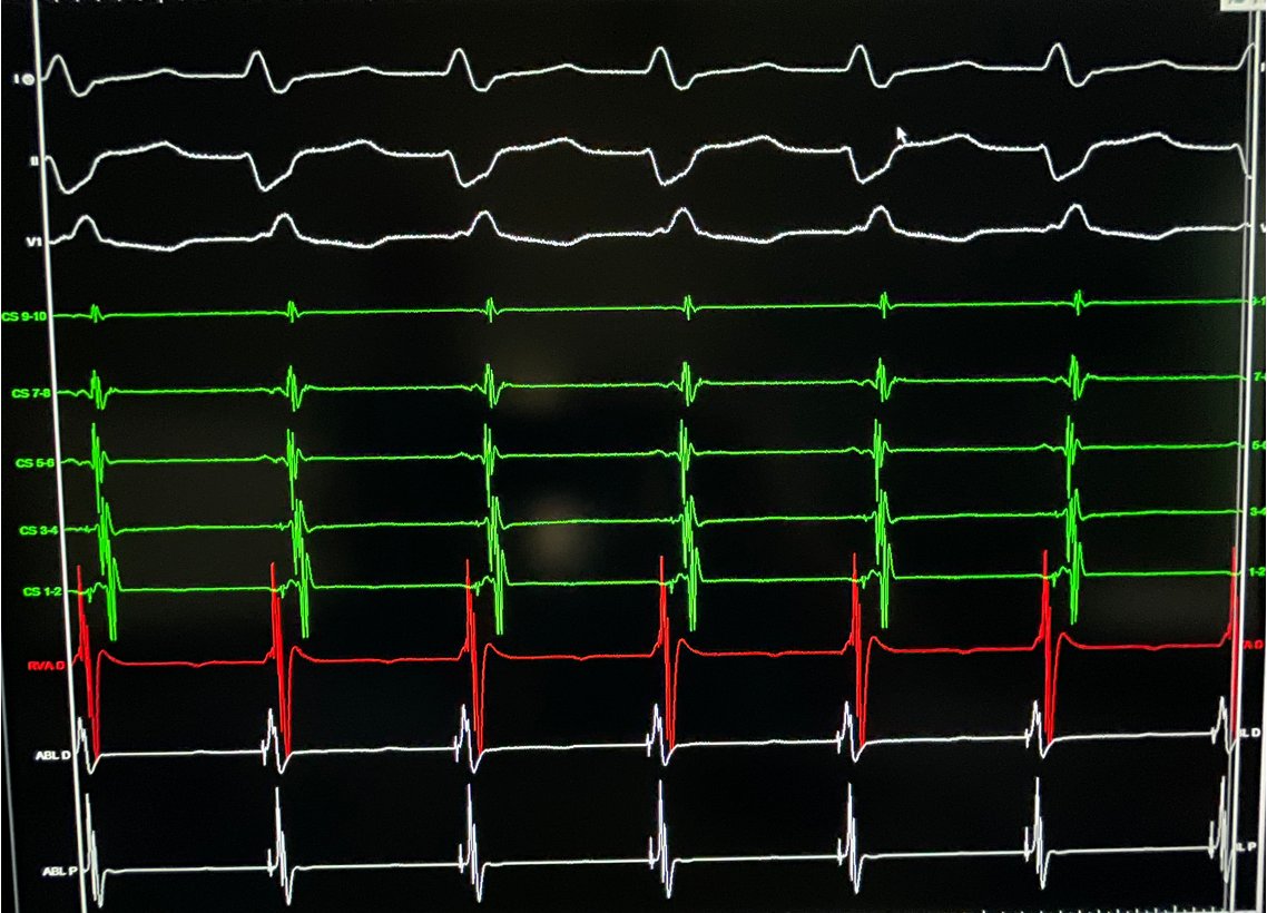 📣 Important lesson for EP fellows! Fascicular VT misdiagnosed as AVNRT elsewhere (1:1 VA conduction) led to unsuccessful abl and iatrogenic RBBB 😔 Fortunately, the condition was successfully ablated by identifying Purkinje potential. #EPeeps #CardioTwitter