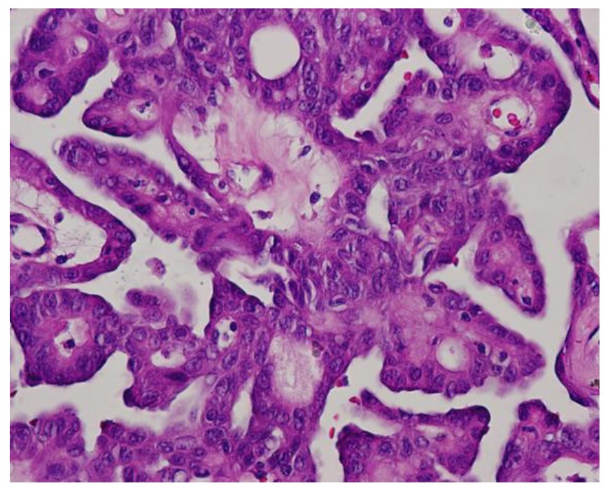 Cribriform morular #thyroidcancer no longer considered a variant of PTC. Now listed as one of the “Thyroid tumors of uncertain histogenesis”.  bit.ly/3Nb7WOh