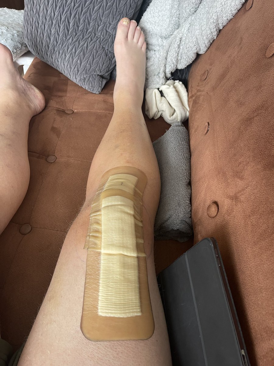 kooswijma's tweet photo. Als je nieuwe knie nog niet in de gaten heeft dat ie moet ophouden met zeuren #napijn #nieuweknie #patient #banktweet https://t.co/GFiuxy4c0i
