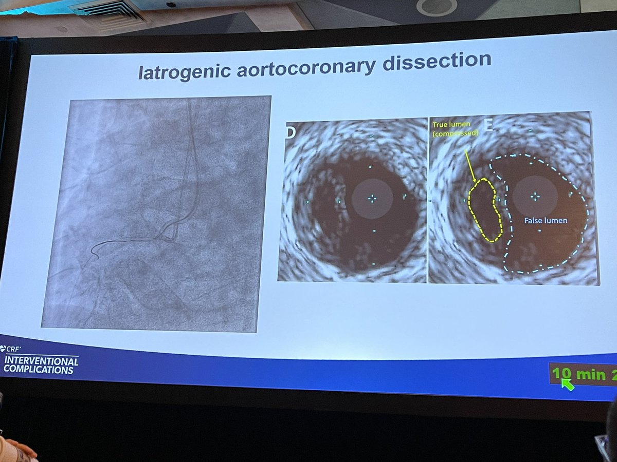 stefan_harb's tweet photo. @TCTMD @crfheart @KambisMashayek1 sharing dissection management at #CompCourse2023
@JTiwanaMD @RhianEDavies1 @KateKearney4 @SanjogKalra on the panel https://t.co/Qny2ZRURGa