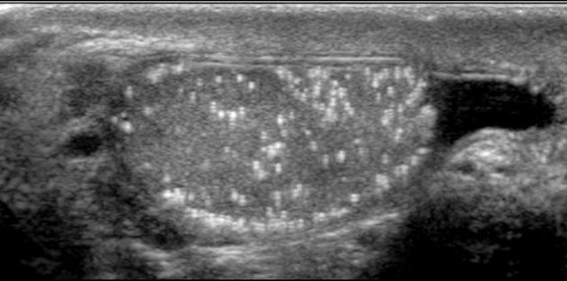 RT @Sthanu5: History of mild trauma to the scrotum. Otherwise asymptomatic.
Diagnosis? https://t.co/1KsMYCeVaV