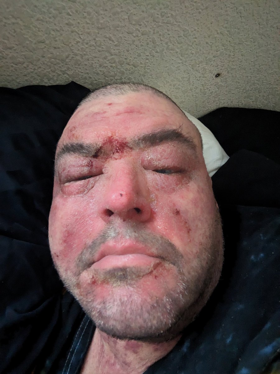 bigray's tweet image. Hey @VancityReynolds , I think my chemo has turned me into Deadpool