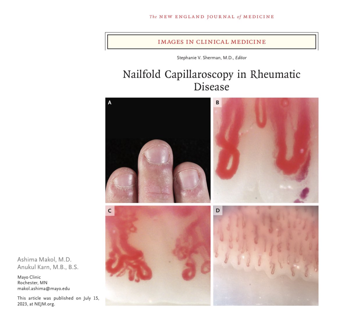 AshimaMakol's tweet photo. 🔥🔥🔥 off the press!

Absolutely thrilled to see &amp; share with you our Image in the @NEJM weekend briefing today!! 

https://t.co/HObU6SzcBq

#NailfoldCapillaroscopy 🖐️
#Dermatomyositis 
#MayoClinicRheumatology 
#RheumTwitter 
#MedTwitter https://t.co/net56cOa64