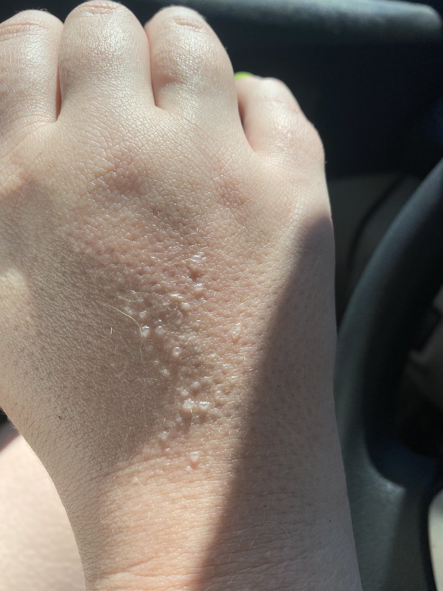 PSA to wear sunscreen oh my god wear sunscreen i got badly sunburnt a week ago and this is my hand today after a ~20 minute walk in mostly shade while wearing SPF70. you can’t really un-damage your skin.

💜 WEAR SUNSCREEN 🩷