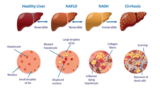 drjoharji1's tweet photo. NAFLD
The silent epidemic

لا تستهين بدهون الكبد 
فهي ليست مزحة 

دهون الكبد قد تتحول بمرور الوقت الى التهابات في الكبد NASH 
وتتحول الى تليفات في الكبد 

وقد تتحول التليفات الى سرطان كبد

الثمن الي تدفعه اليوم في صحتك وغداءك ورياضتك وادويتك

لا يقارن بقيمة كبدك https://t.co/WJs1UuiM81